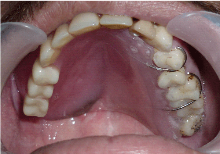 Single Step Fabrication Of A New Maxillary Obturator Prosthesis